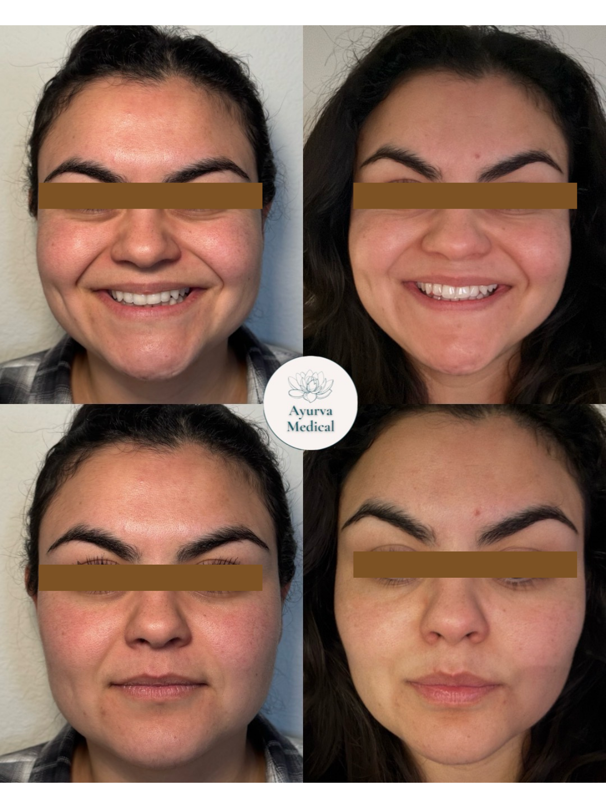 Comparison of two women’s faces before and after skincare treatment, with the 'Ayurva Medical' logo in the center.