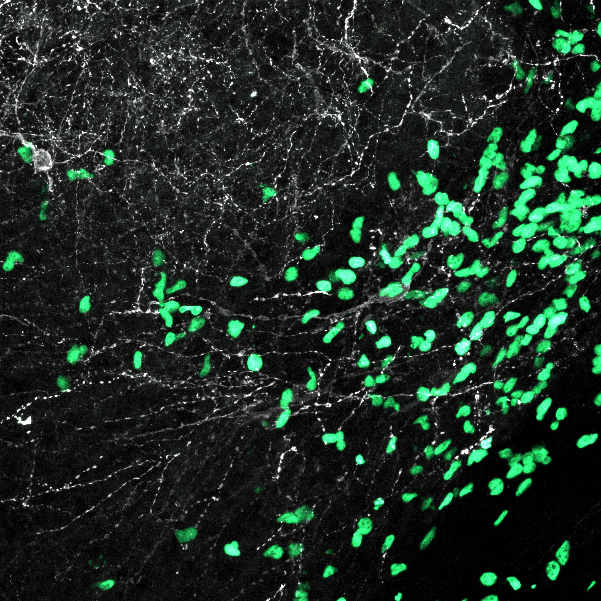 Microscopic view of neural tissue showing many interconnected neurons with green fluorescently labeled cancer cells.