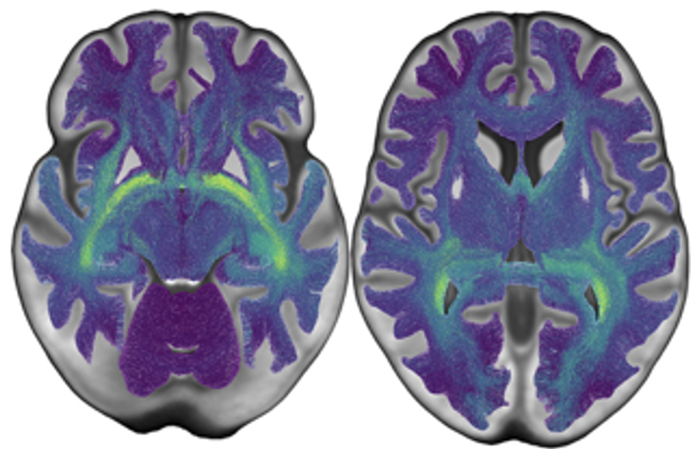Color-enhanced MRI scans of two human brains viewed from above, showing various brain structures in colors like purple, blue, and green.
