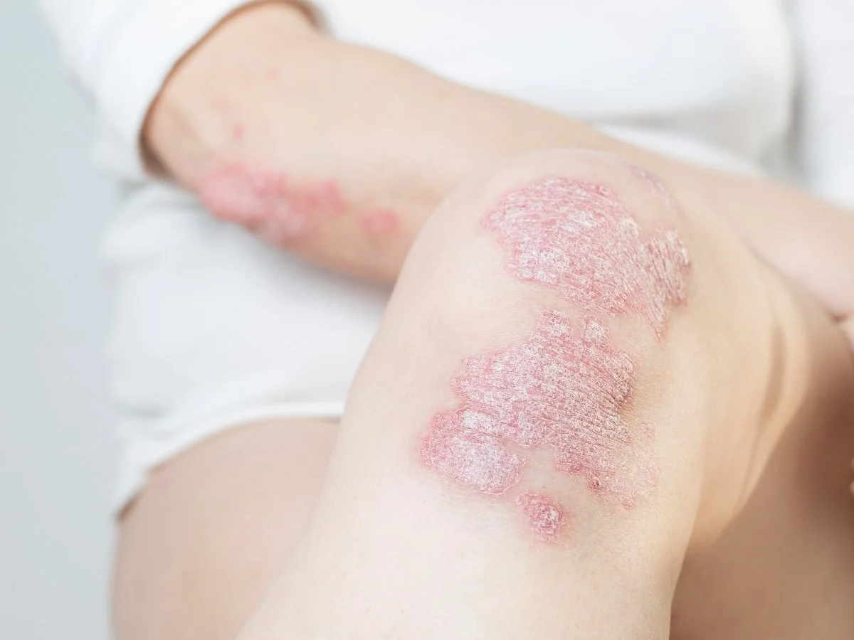 Autoimmune Health &amp; Immune Balance