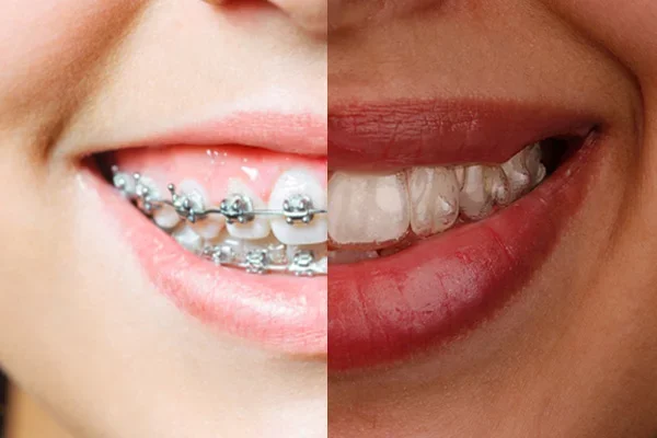 Ortodoncia-invisible-vs-ortodoncia-convencional.webp