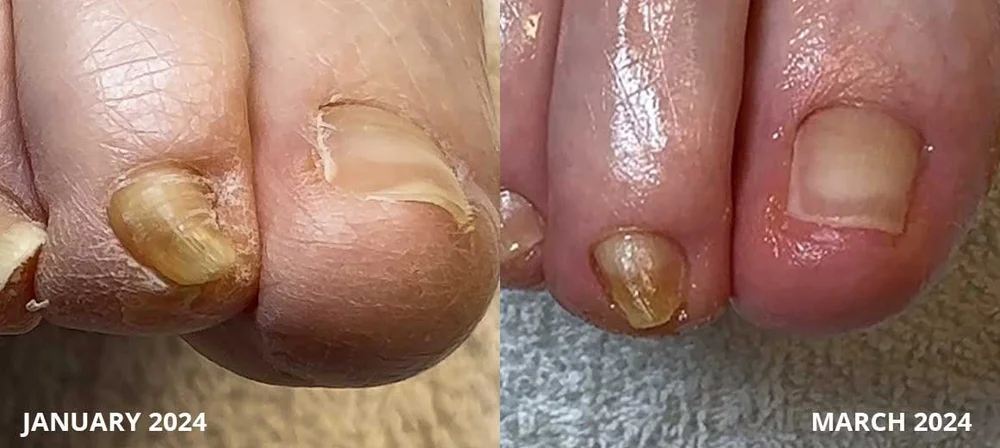 Lifted toenail before and after appearance improvement