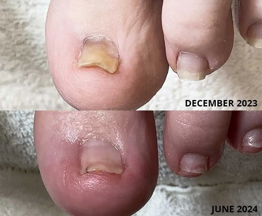 Before and after toenail transformation using correct technique and Restore A Nail
