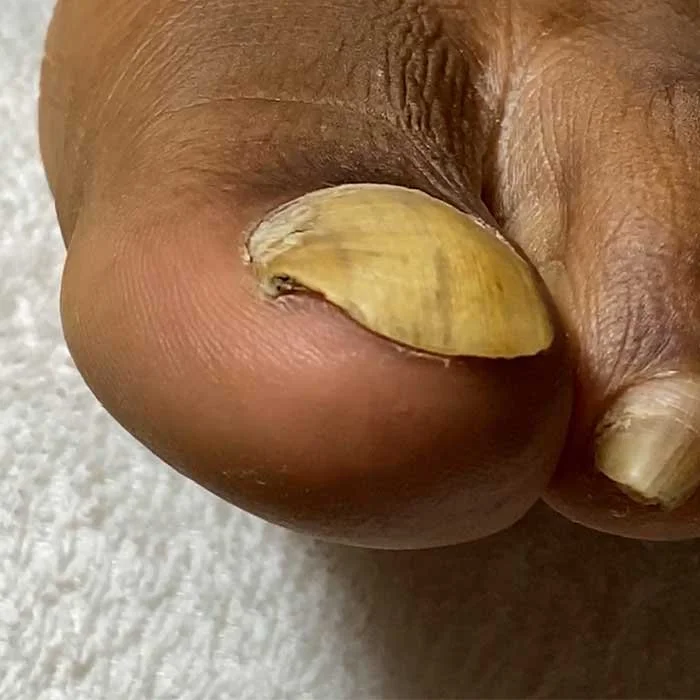 Lifted toenail before Restore A Nail
