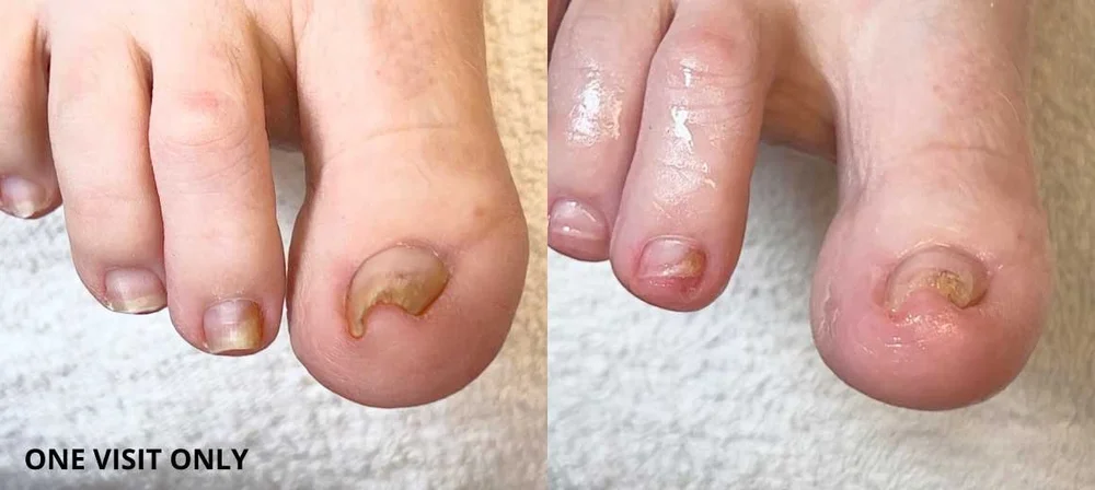 Toenail before and after Restore A Nail result