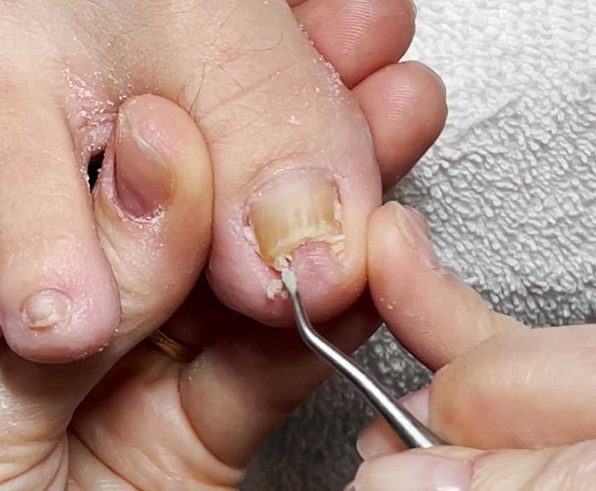 Step 2 clean and reduce thick toenail before Restore A Nail