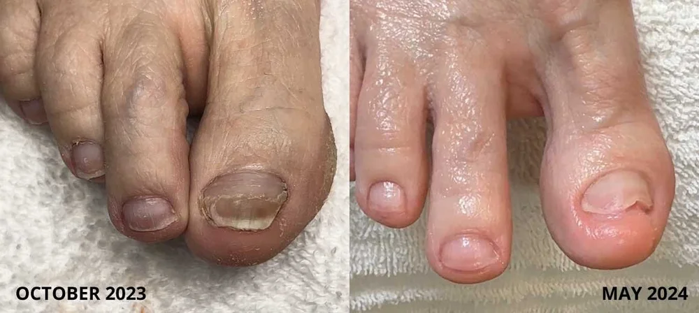 Damaged toenail before and after cosmetic improvement