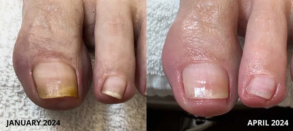 Yellow toenail before and after Restore A Nail