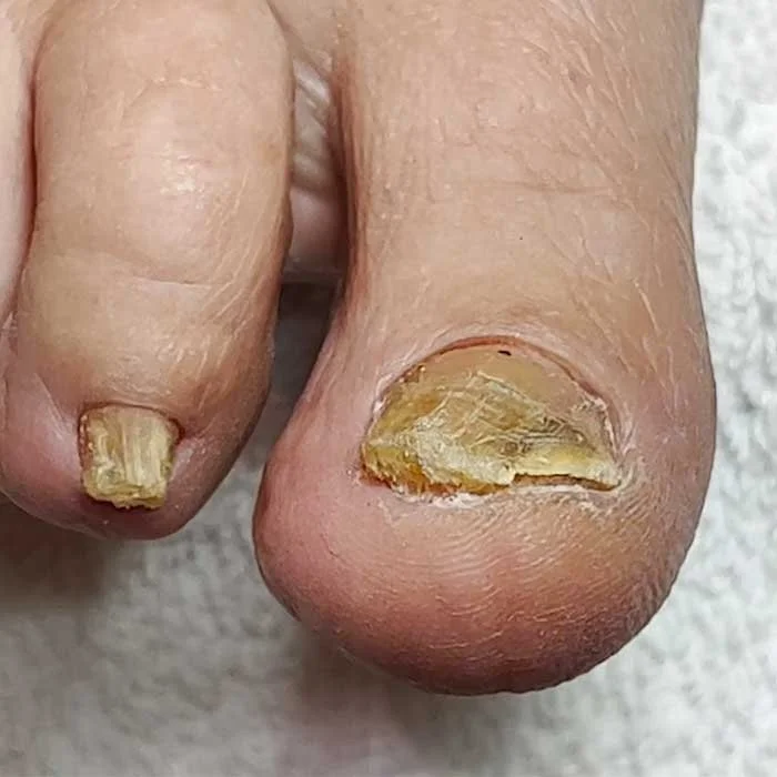 Yellow toenails before Restore A Nail