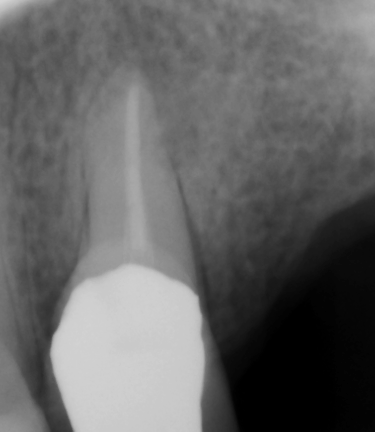 2D X-ray showing the root apex of a tooth
