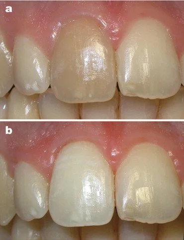 Close-up of front teeth showing before and after internal bleaching, with the upper image depicting a discolored tooth and the lower image showing brighter, whitened tooth.