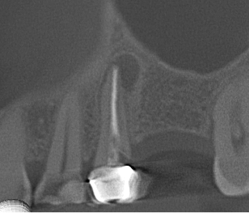 3D slice of a tooth showing a clear radiolucency at the apex