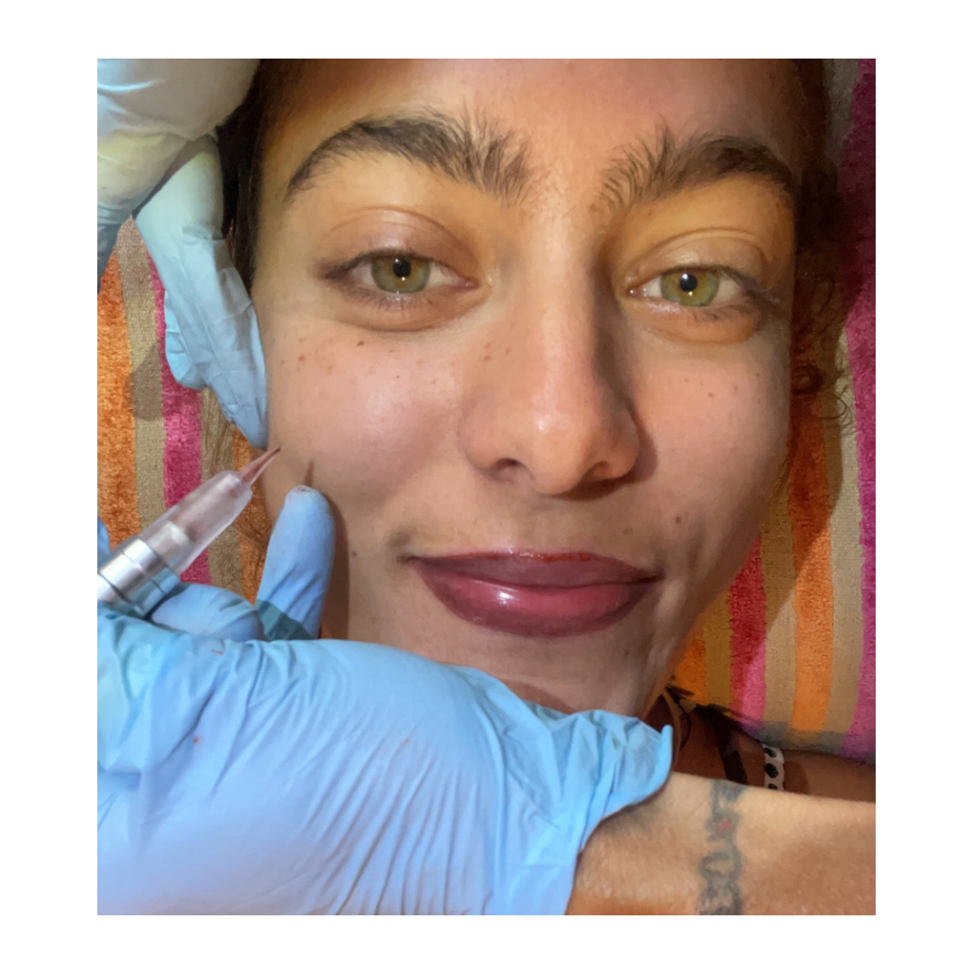 In progress: combined lip blush, lip liner, and freckle treatment