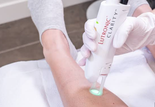 Clarity II laser hair removal treatment at GLOW Korean Laser in Lakewood, Washington.