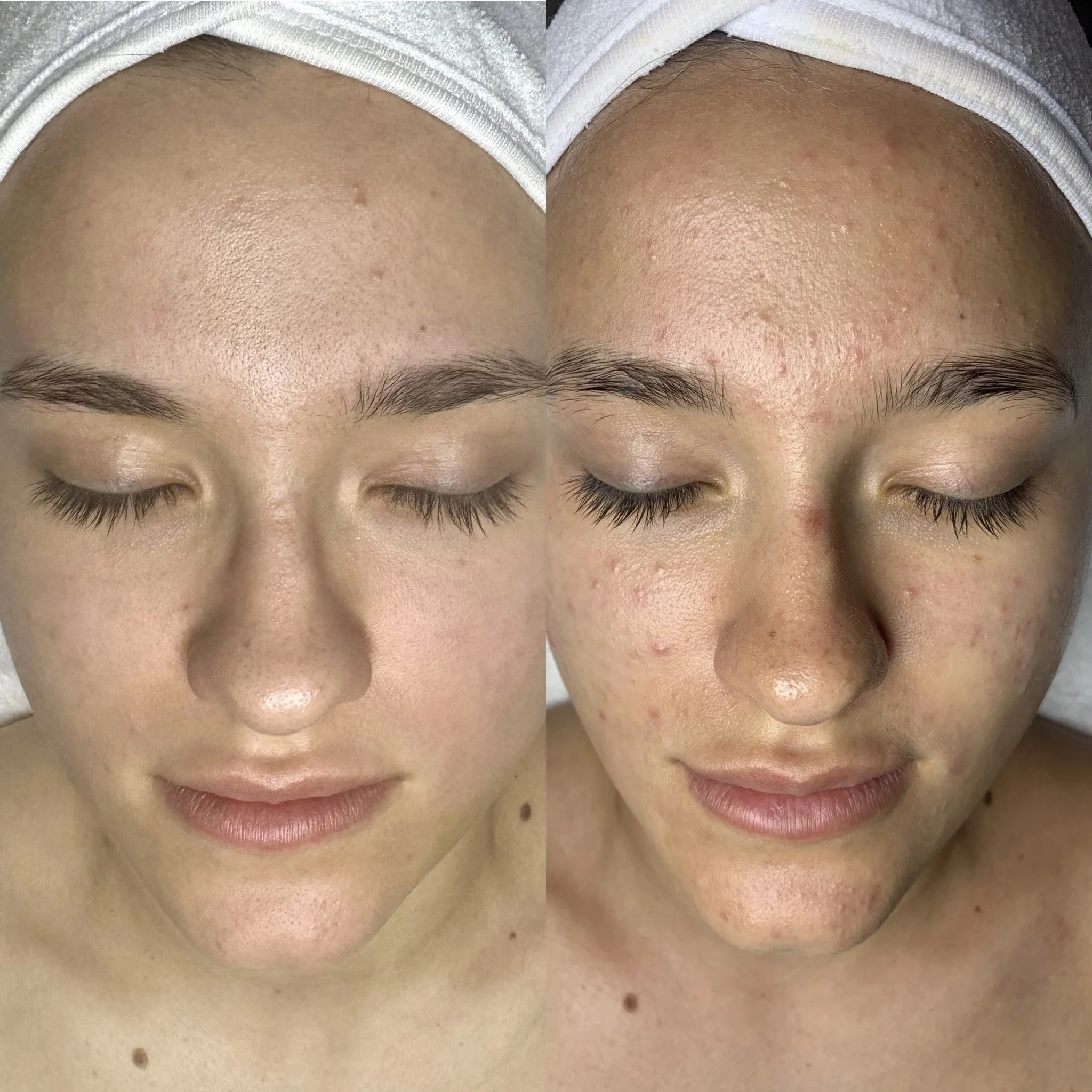 Close-up of a person's forehead, eyebrows, and partially closed eyes, showing smooth skin with a few small blemishes and some tiny pimples.