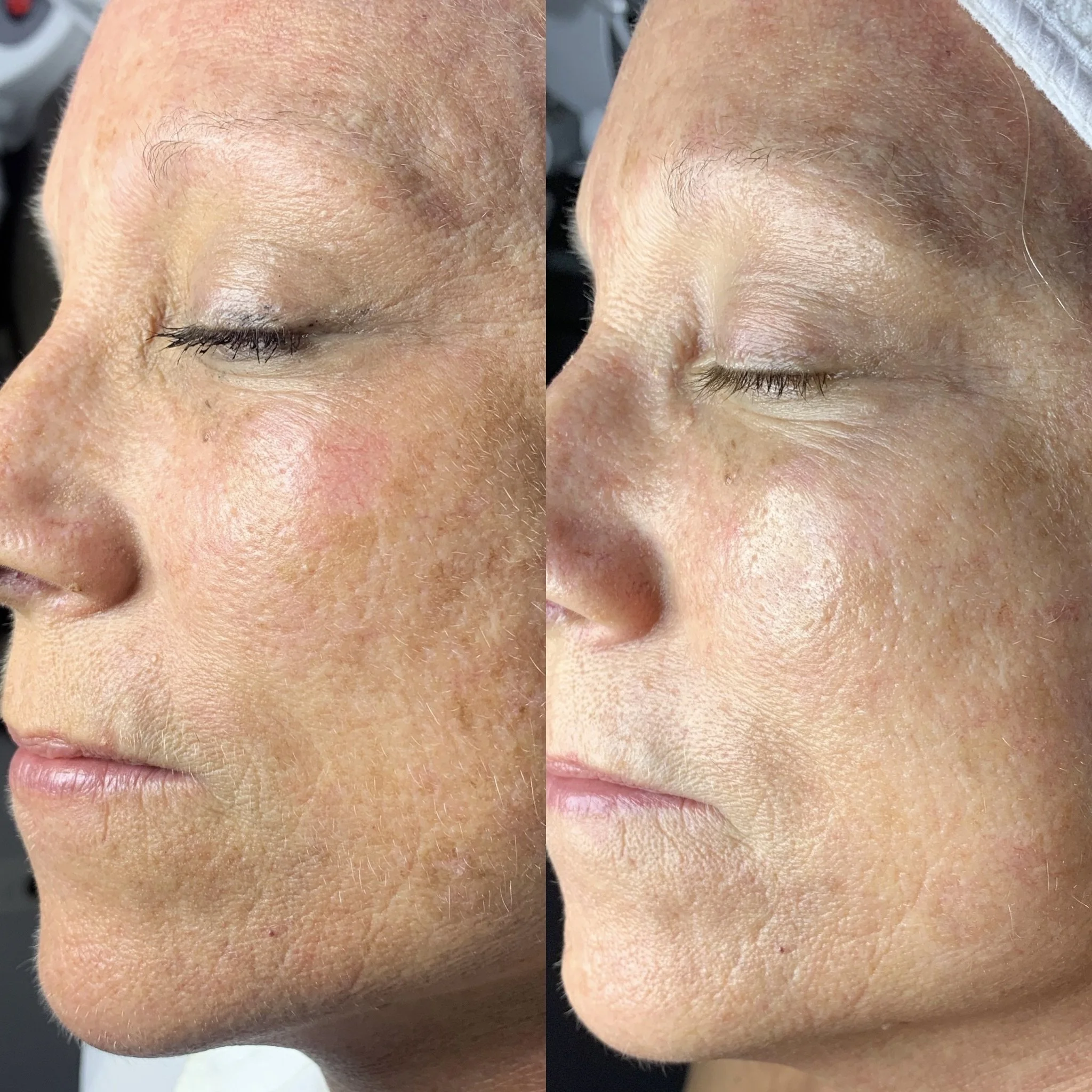 A side-by-side comparison of a person's skin before and after skincare treatment, showing improved skin texture and reduced redness in the after photo.
