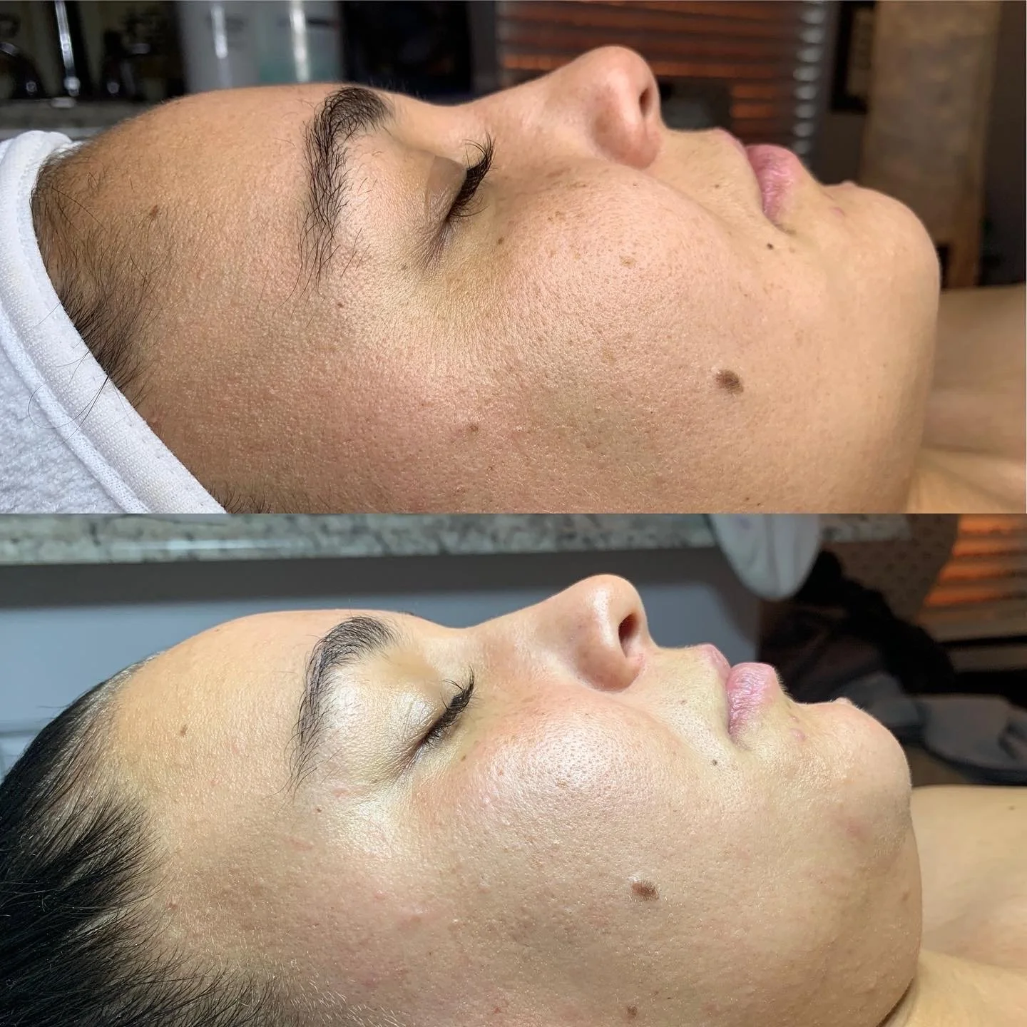 Side view of a woman's face before and after a skincare or facial treatment, showing improved skin clarity and texture.