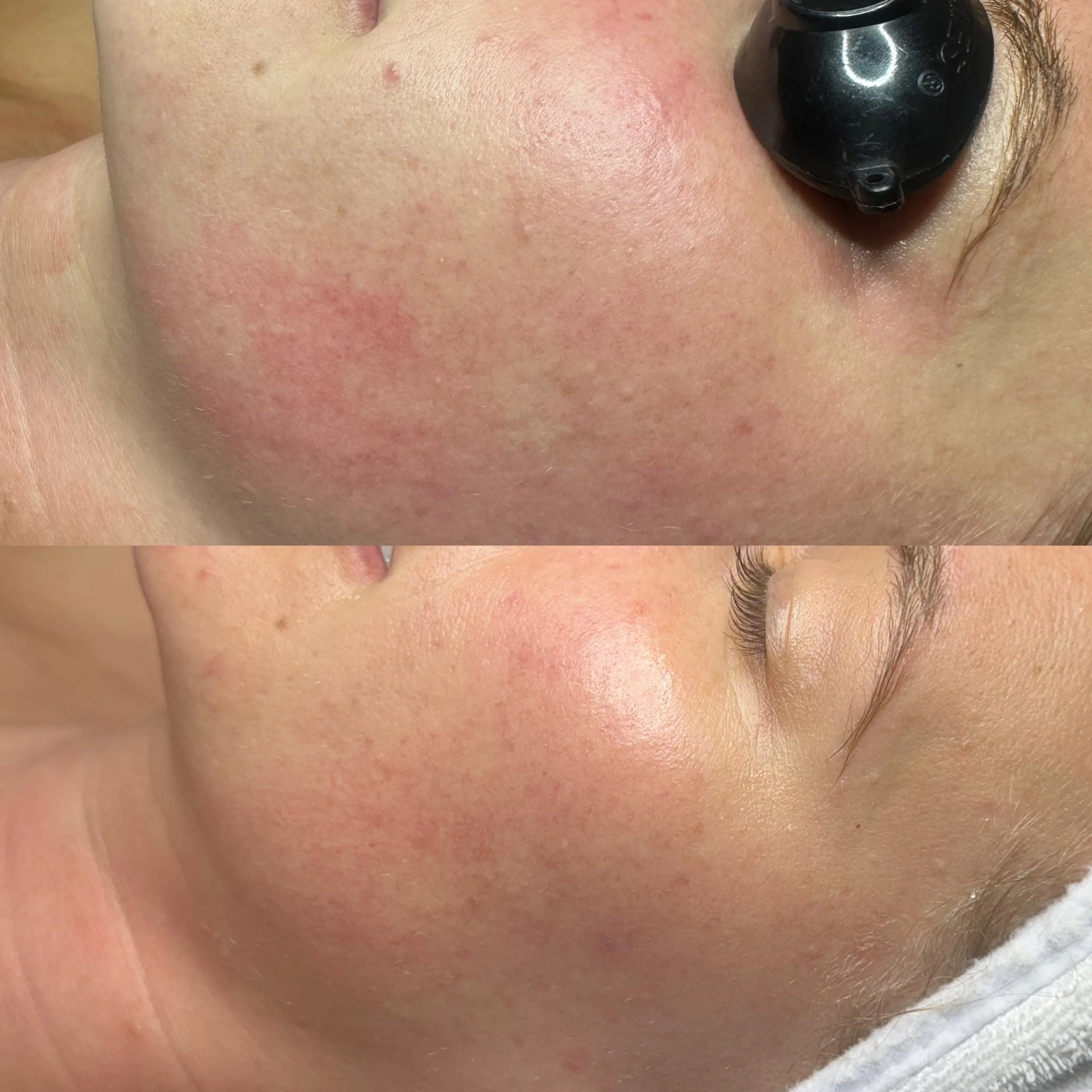 Close-up of a person's face showing skin redness, small pimples, and a mole, with a black facial device near the cheek and part of an eyebrow and eyelashes visible.