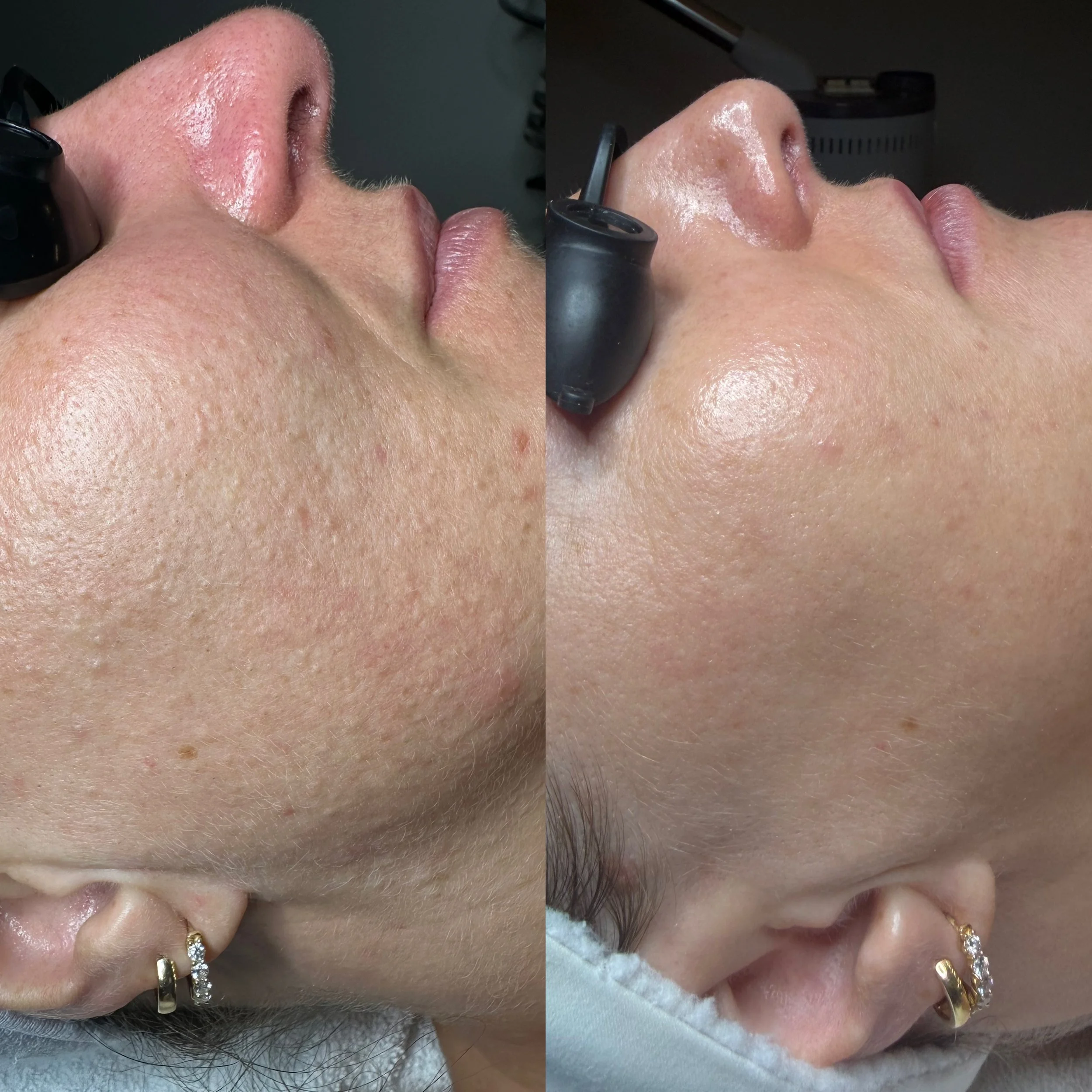 Comparison of a person's chin and neck area before and after a skincare or cosmetic treatment. The left side shows the skin with more visible pores and some redness, while the right side shows smoother, clearer skin with less visible pores.