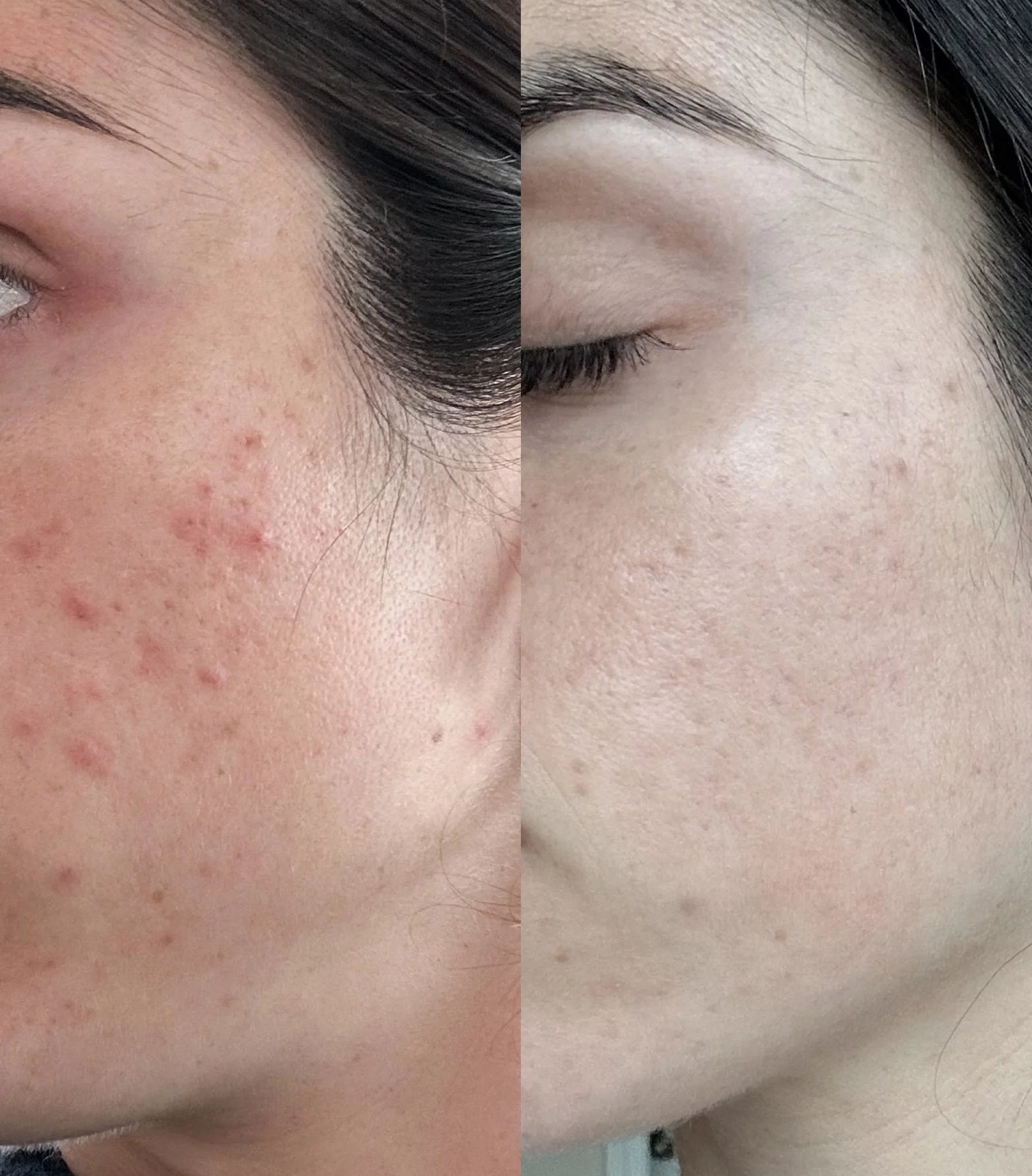 A side-by-side comparison of a person's forehead and eye area before and after skincare treatment. The left side shows the skin with acne, redness, and uneven texture. The right side shows clearer, smoother skin with reduced redness and imperfections