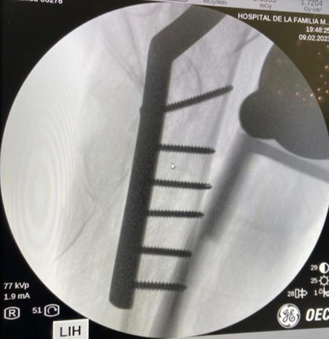 Radiografía de control postoperatorio que muestra la fijación exitosa de una fractura ósea realizada por el traumatólogo Dr. Romero.