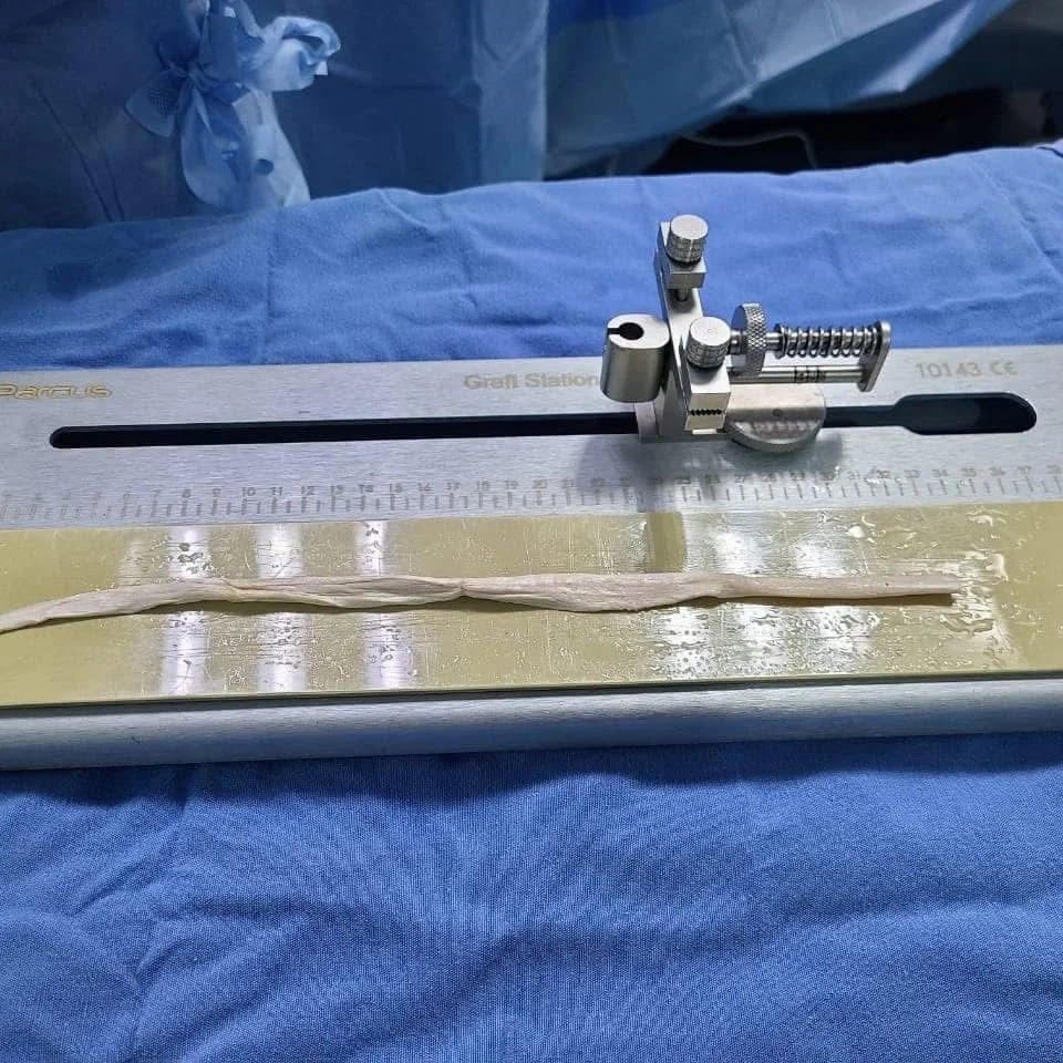 Injerto preparado para cirugía de reconstrucción de ligamento cruzado anterior (LCA) por el Dr. Romero en Mexicali.