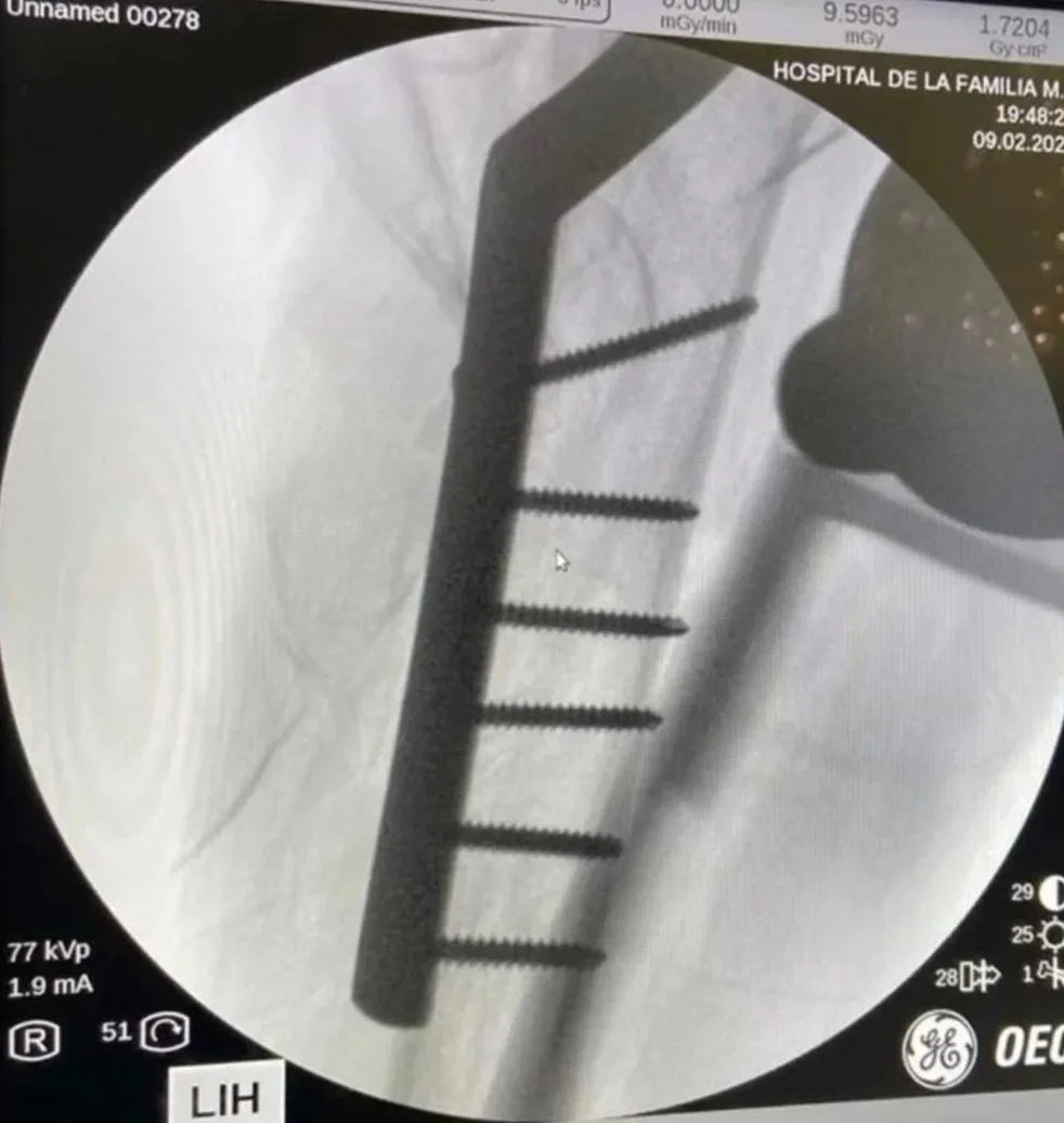 Radiografía de control que muestra la fijación exitosa de antebrazo realizada por el traumatólogo Dr. Romero.