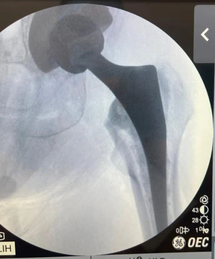 Radiografía de control que muestra la colocación exitosa de una prótesis de cadera avanzada realizada por el traumatólogo Dr. Romero.