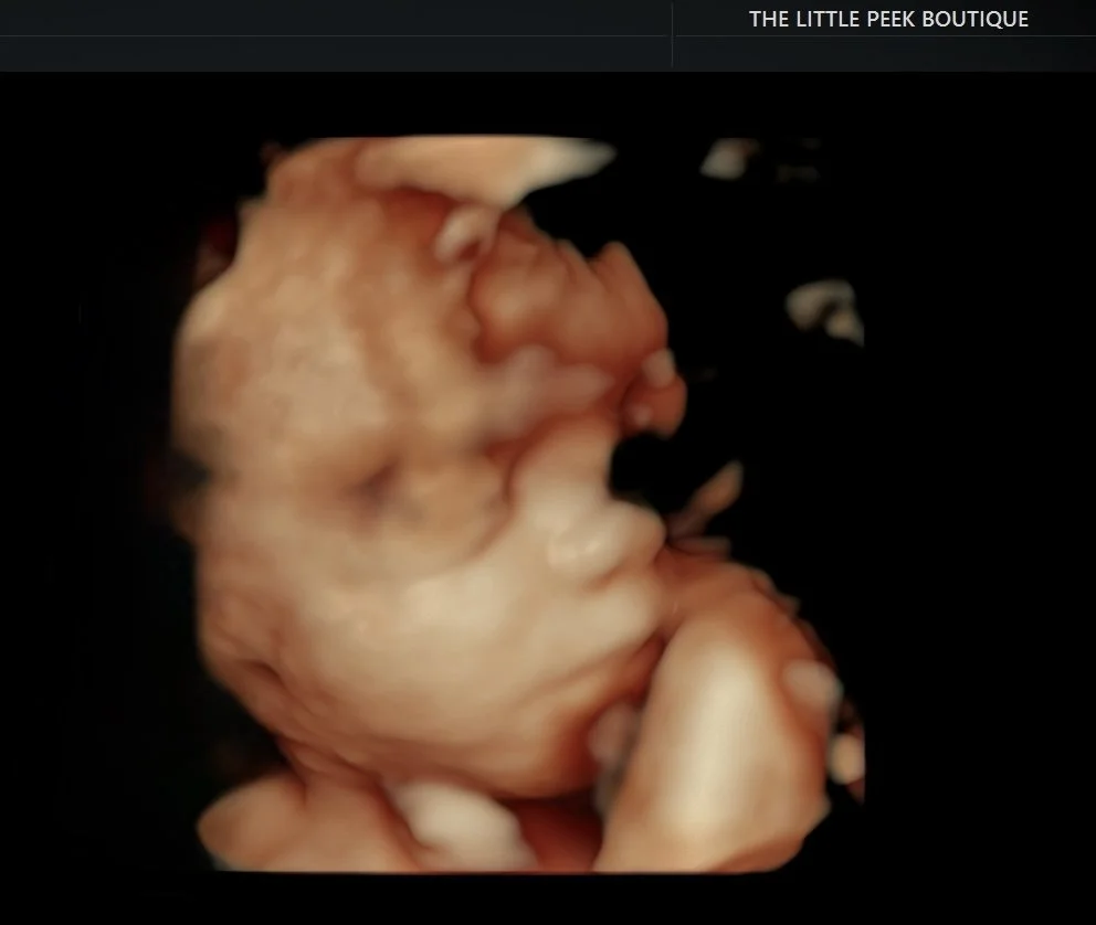 3D ultrasound image of a fetus in the womb