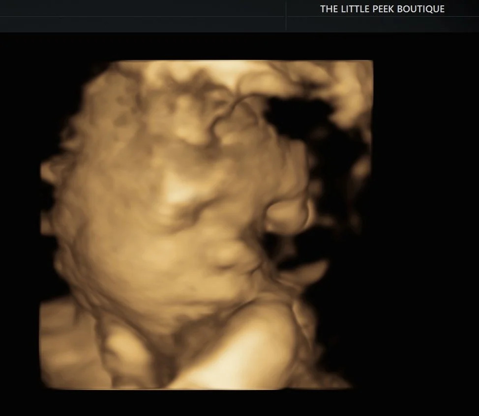 3D ultrasound image of a sleeping baby fetus.