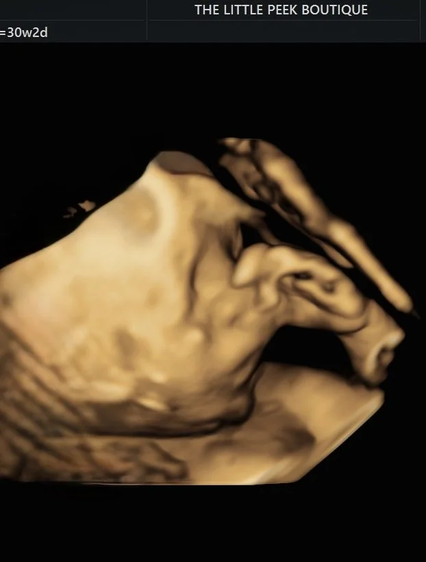 3D ultrasound image of a fetus.