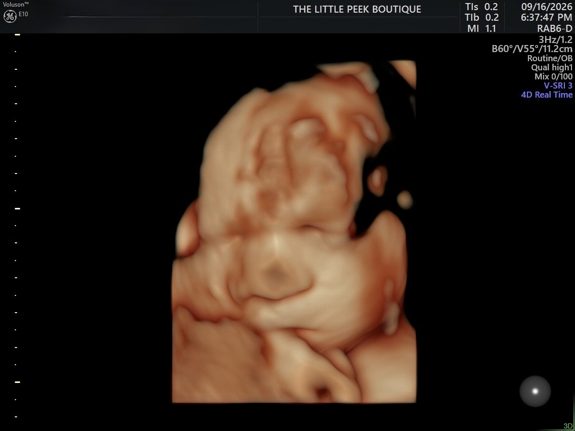 3D ultrasound image of a developing fetus in the womb.