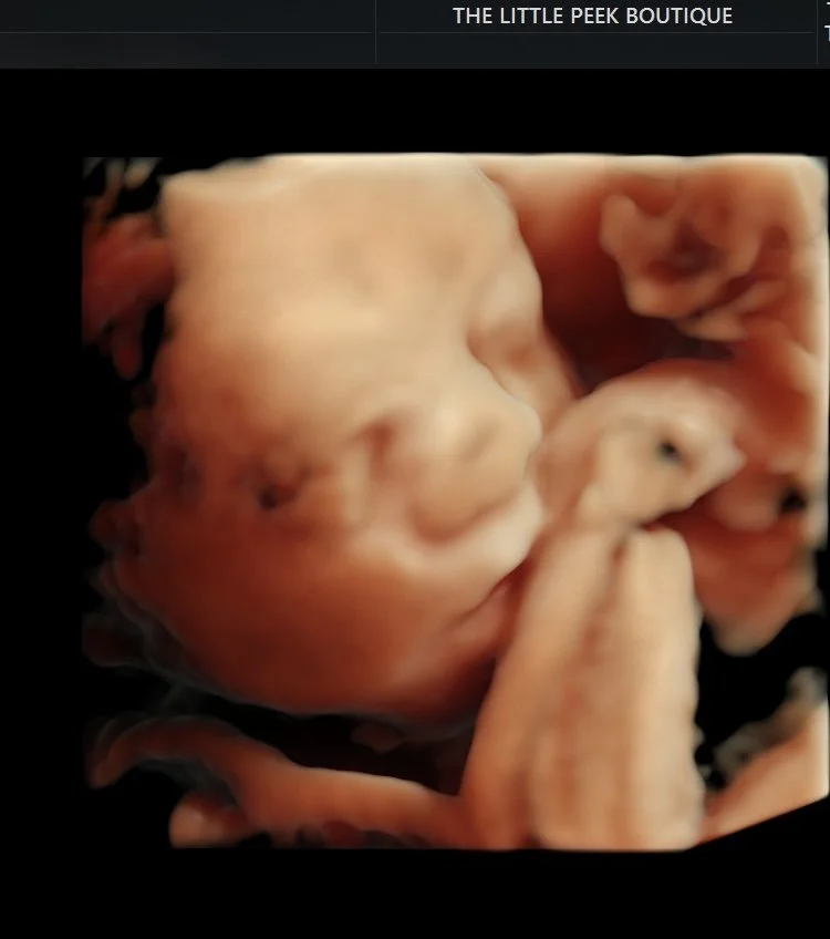 A 3D ultrasound scan of a fetus showing a baby's face with closed eyes and a hand near the face.