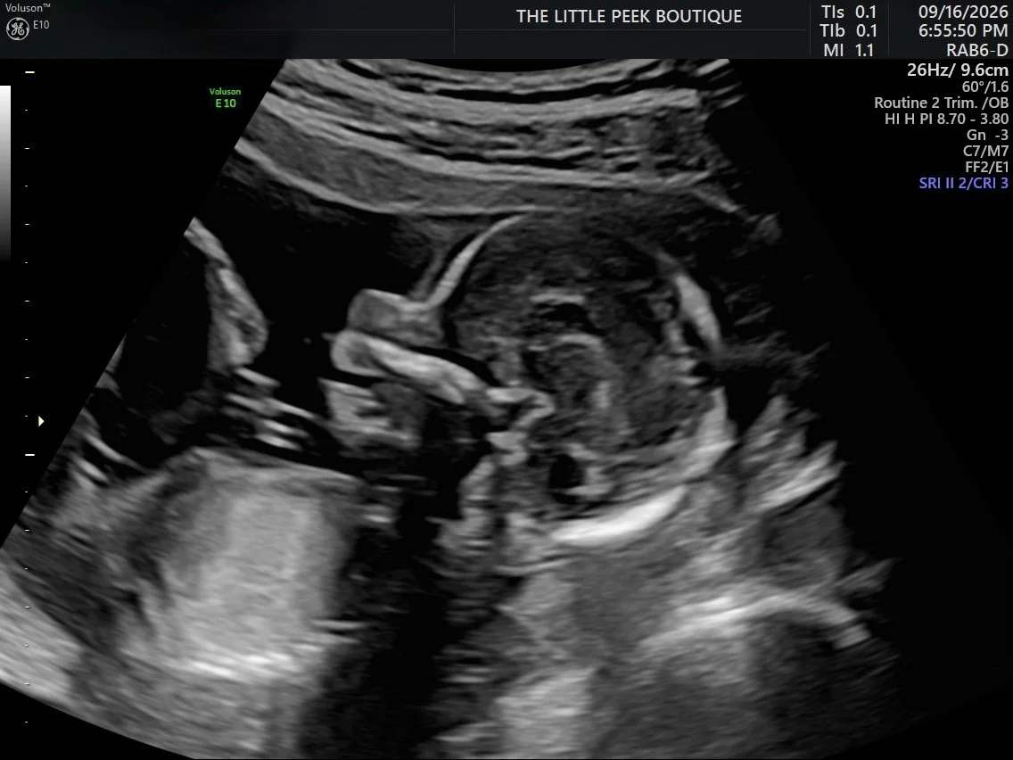 Ultrasound of a fetus in mother's womb, showing a profile view of the baby's head and body.