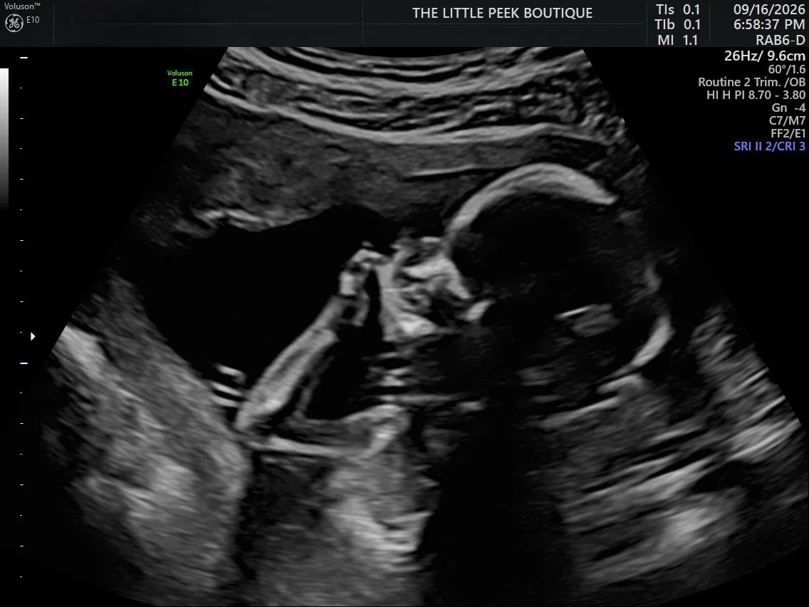 Ultrasound image of a fetus inside the womb.