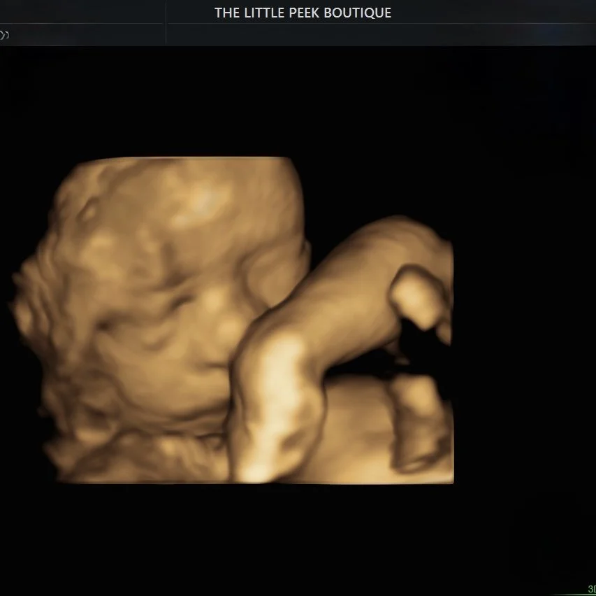 3D ultrasound image of a fetus.
