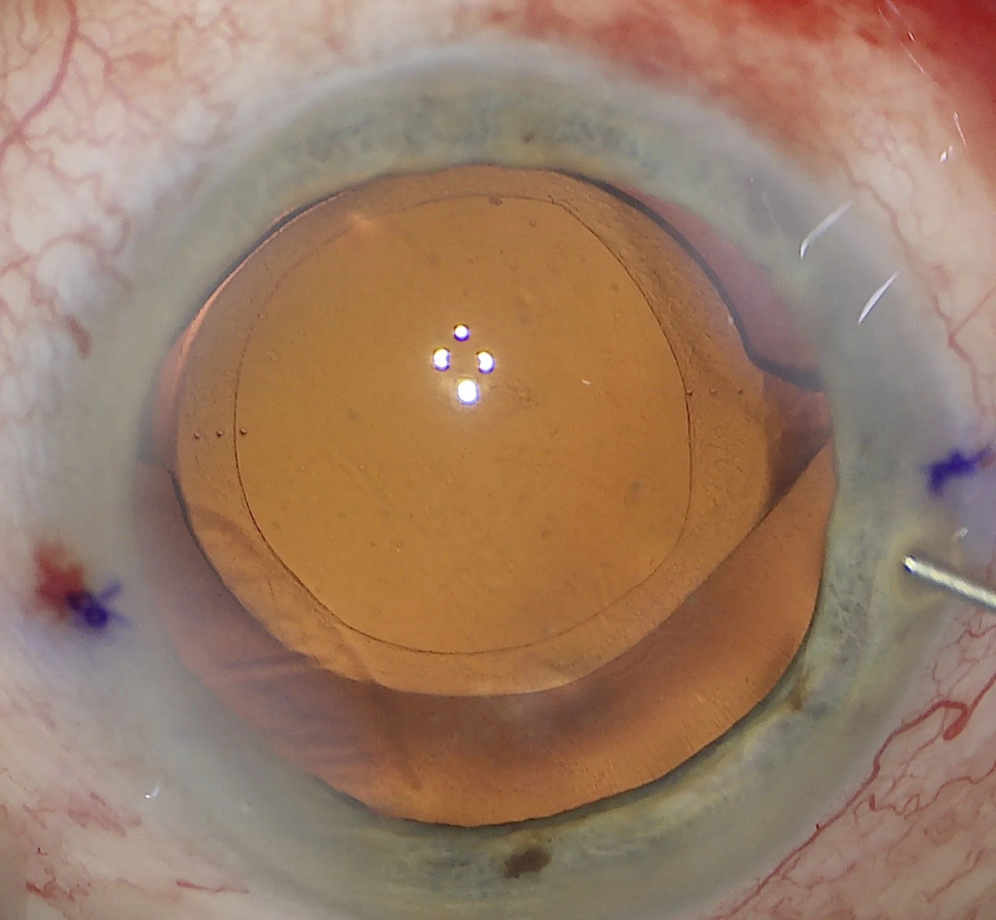 Cataract Surgery
