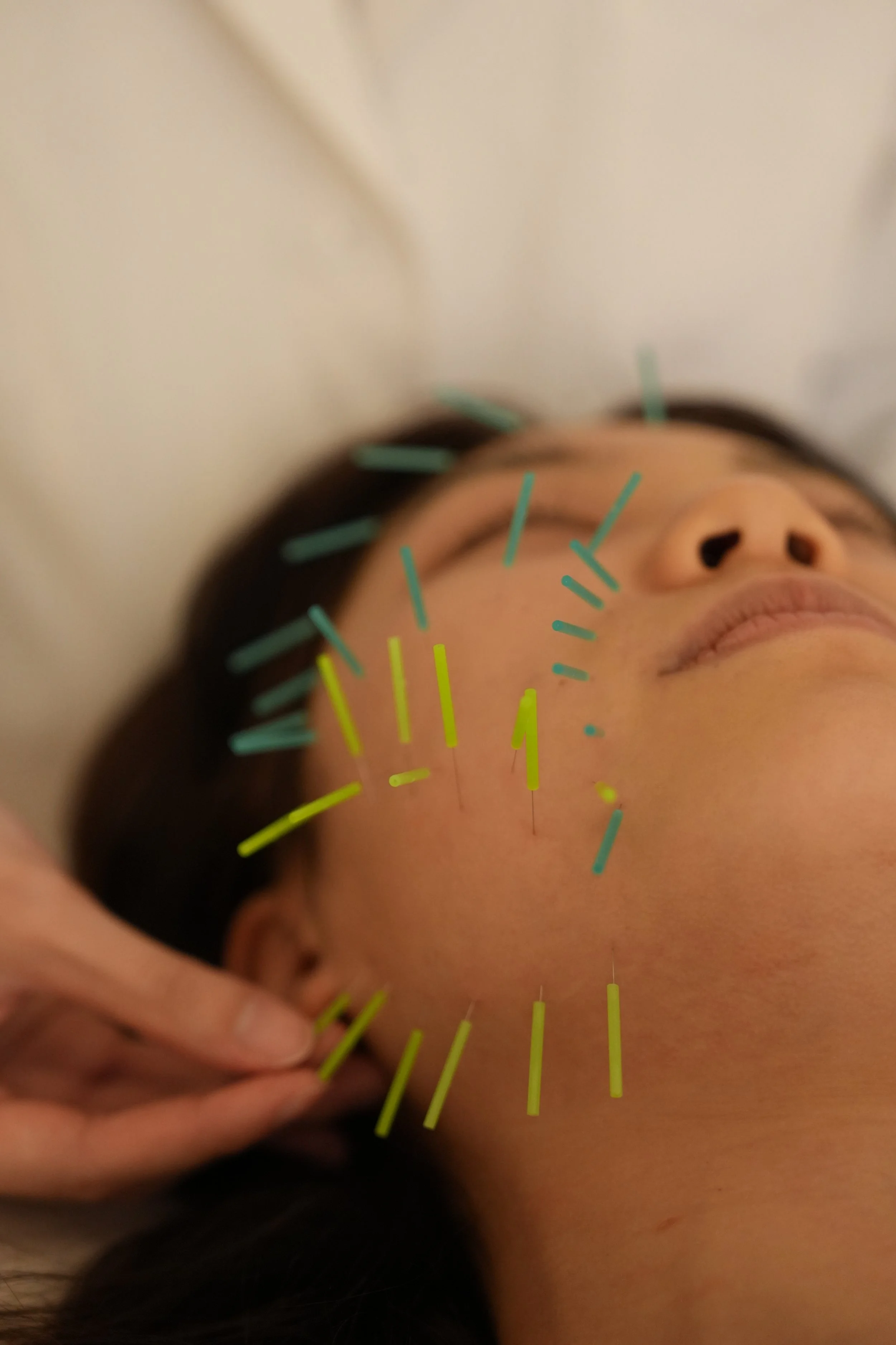A woman lying down with acupuncture needles inserted into her face, receiving acupuncture treatment while wearing a headband.