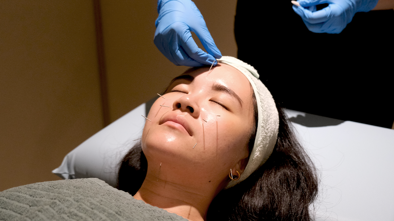 A woman lying down with acupuncture needles inserted into her face, receiving acupuncture treatment while wearing a headband.