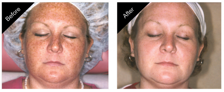 Side-by-side comparison of a woman's face before and after skincare treatment, showing reduced freckles and even skin tone.