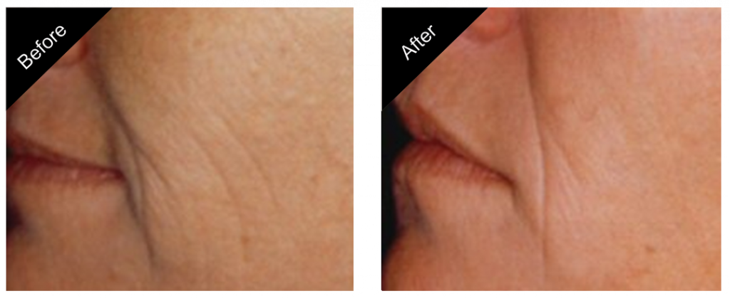 Comparison of skin texture and wrinkles on an older person's face before and after a treatment, showing reduction in wrinkle depth and skin smoothness.