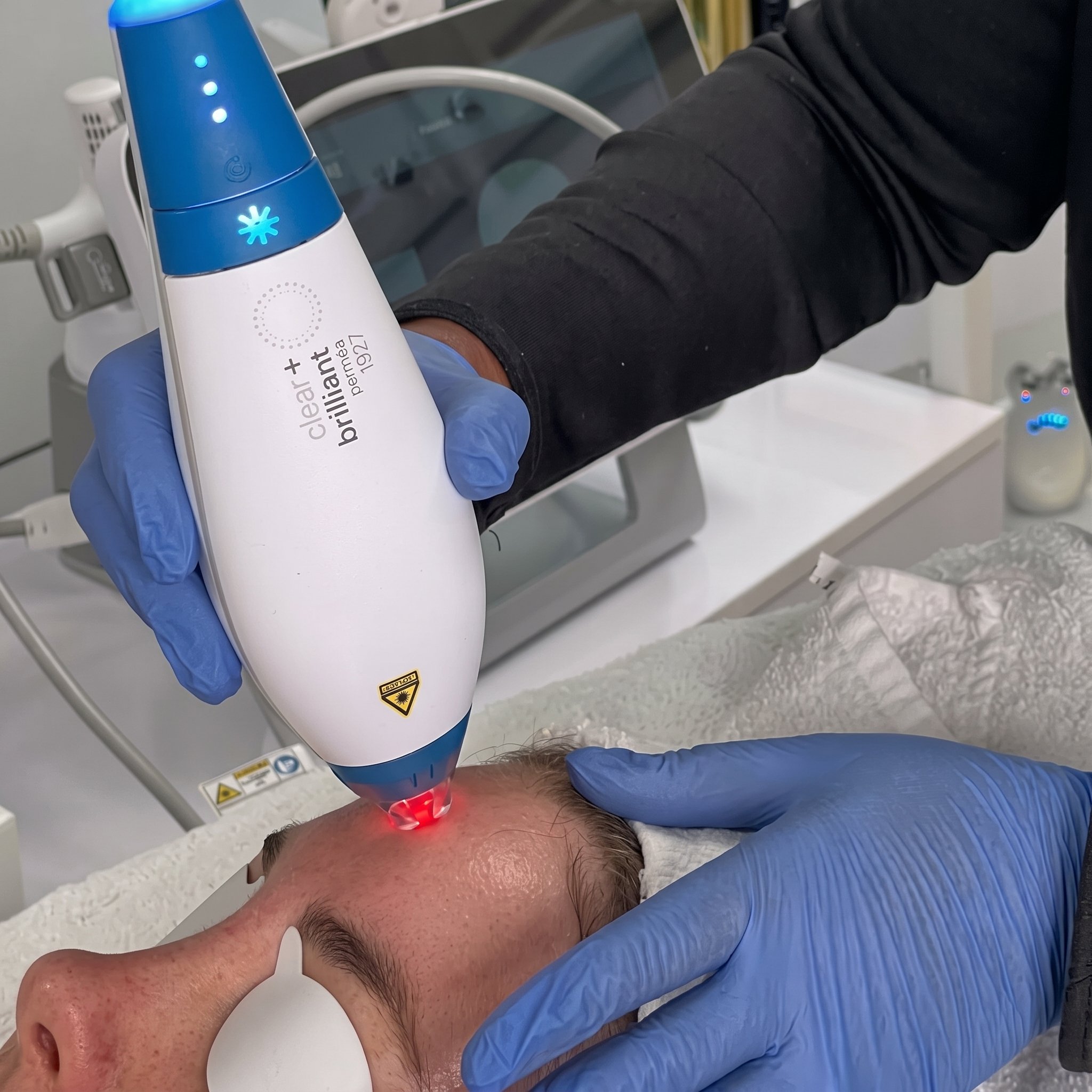 A person receiving a laser treatment on their forehead at a medical facility. The technician is wearing blue gloves and holding a device emitting red laser light. The person has short hair and is lying down with their head slightly tilted back.