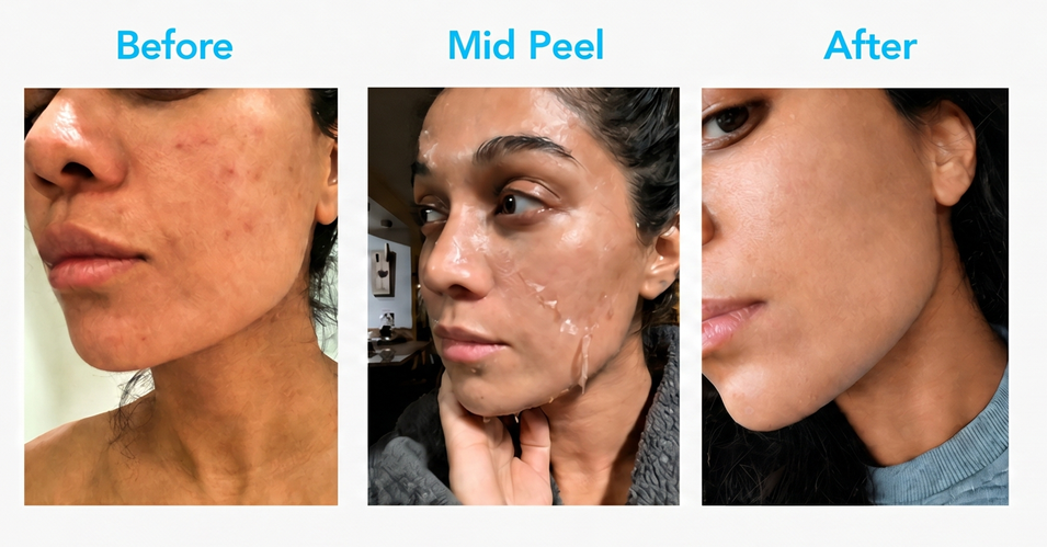 Comparison of a woman's facial skin before, during mid peel treatment, and after skin resurfacing. The "before" image shows skin with redness and blemishes, the "mid peel" image shows peeling skin, and the "after" image displays clearer, smoother skin.