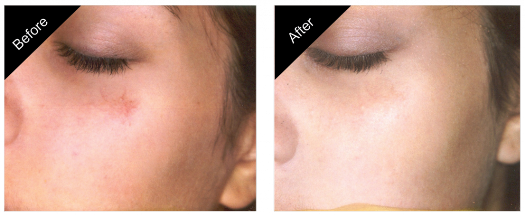 Side-by-side comparison of a person's cheek showing improvement in skin condition, labeled 'Before' and 'After'