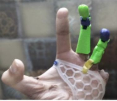 Hand with two colorful prosthetic fingers and a white honeycomb-patterned bandage.