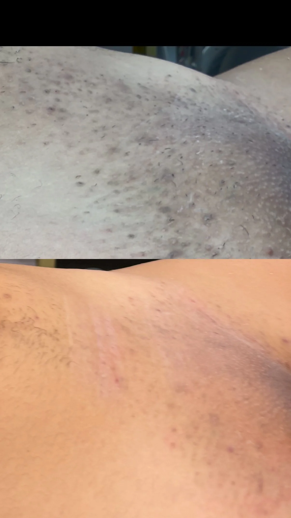 Comparison of ingrown detox treatment, before and after. The skin is less congested and brighter toned after the service in the bottom picture.