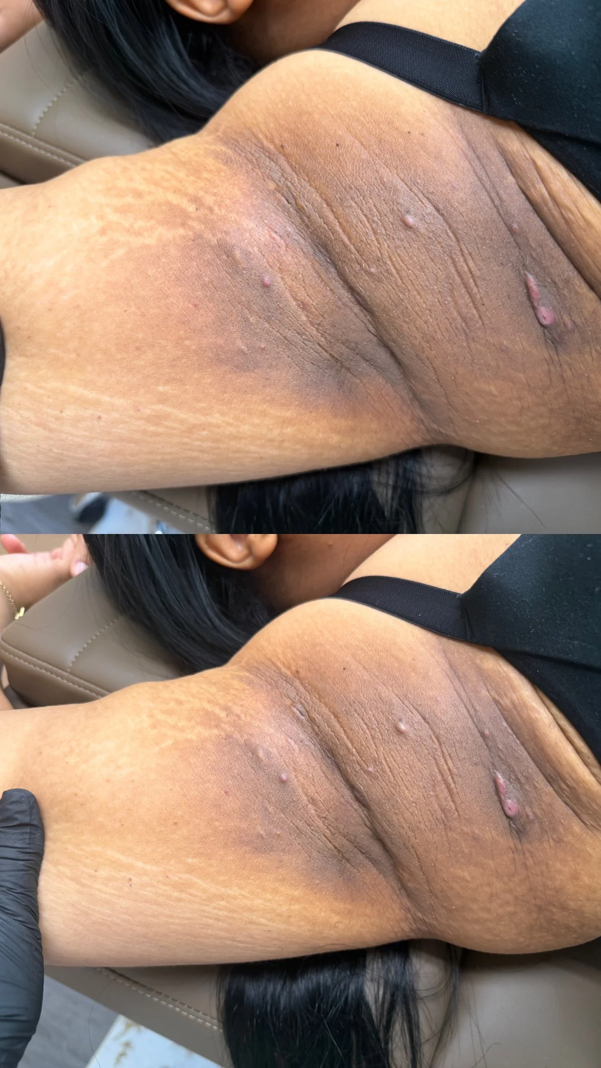 Close-up of a person's armpit with skin irritation and small bumps and discoloration.