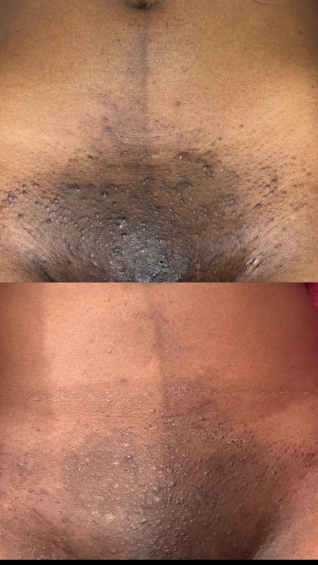 Close-up of vaginal bleaching showing comparison of texture and discoloration improvement.