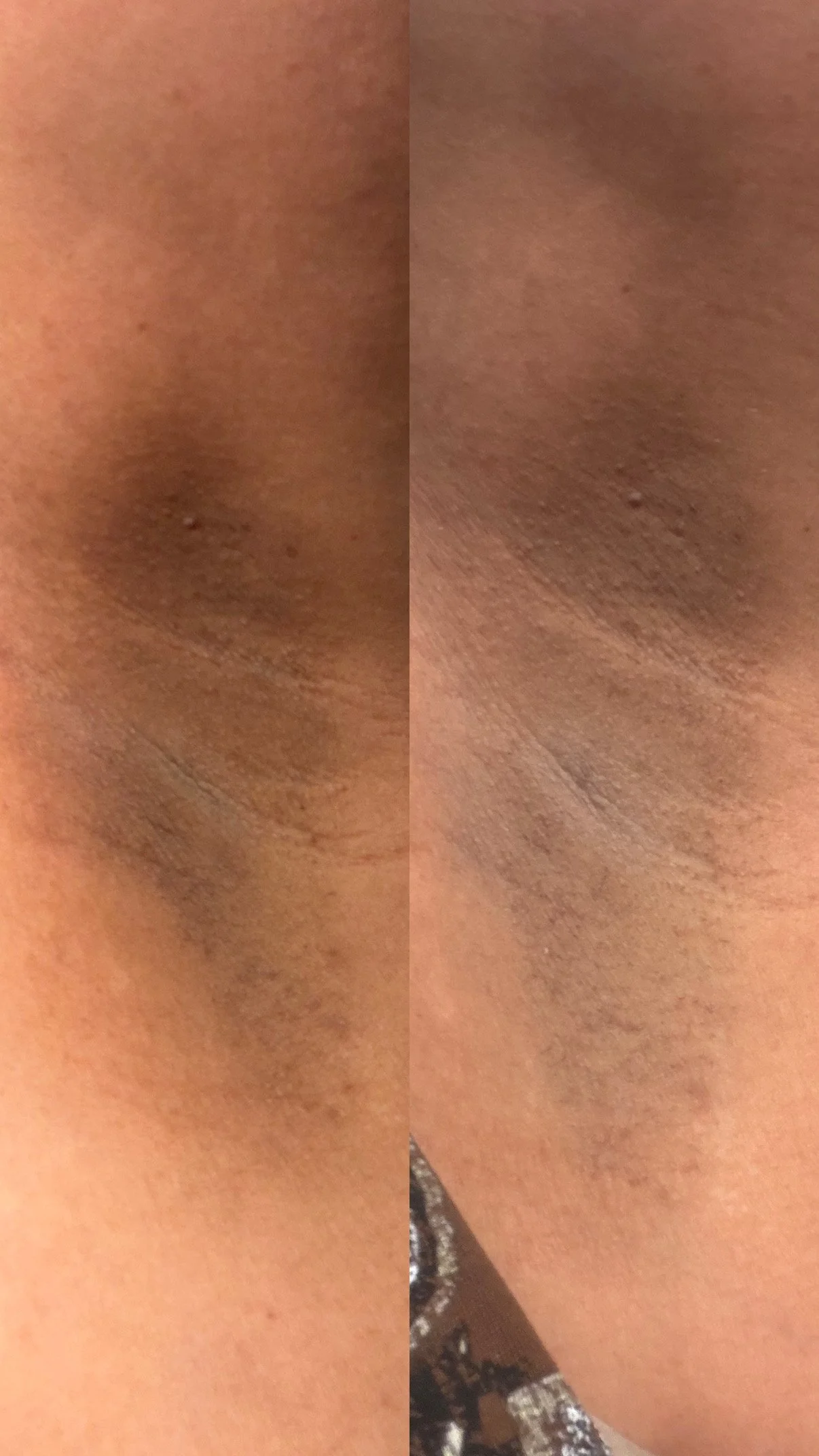 Comparison of a level one underarm bleaching. The skin is brighter in the right picture compared to the photo on the left.