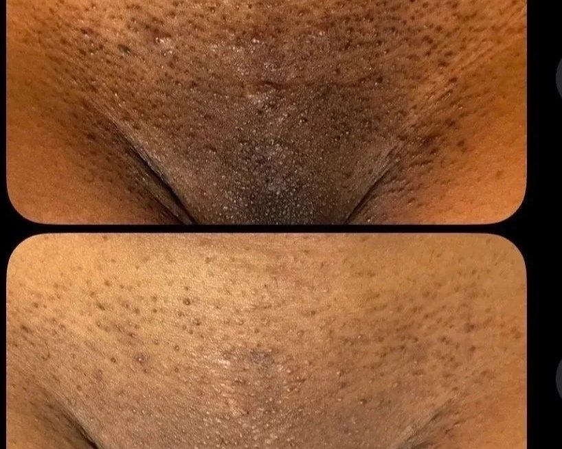Comparison of skin before and after treatment showing reduction in pore size and skin oiliness, congestion and a brighter complexion.